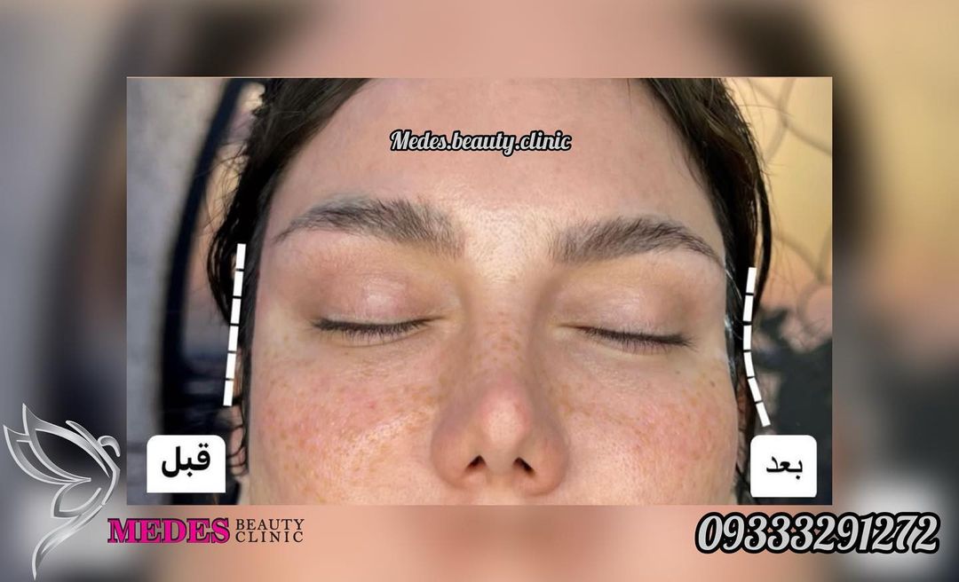 گالری زاویه سازی صورت